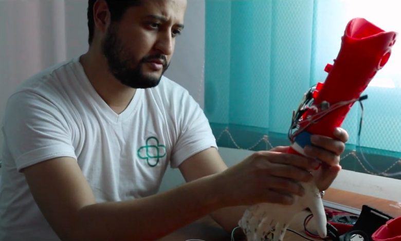 Cure Bionics : main bionique en impression 3D